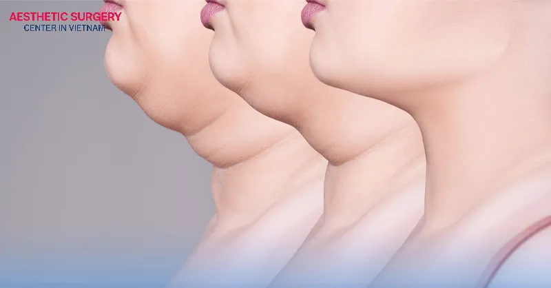 If insurance does not provide coverage, you can consider payment options like installments or unsecured loans to ease the cost burden of chin liposuction.