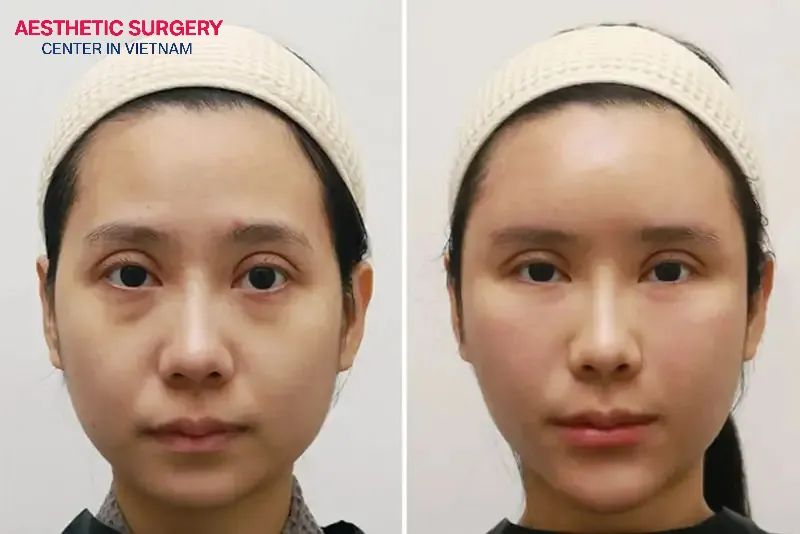 Fat-dissolving injections offer many benefits to users, specifically, they require no surgery, leave no scars, are quick to perform, and have a high safety rate