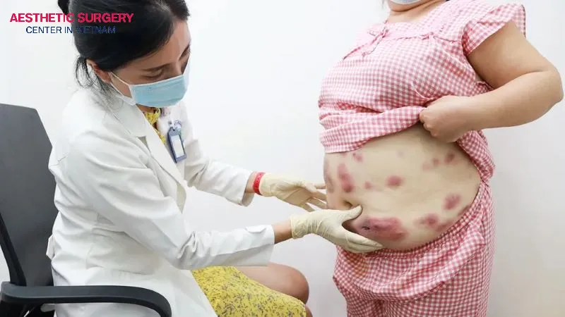 If liposuction is performed using injections at a low-quality facility, it can cause bruising and prolonged pain in the treated area