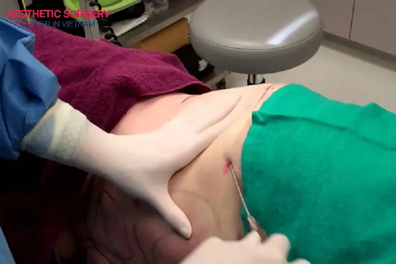 Liposuction of the waist area is a quick and effective method for removing excess fat around the waist, but it needs to be performed by a skilled surgeon