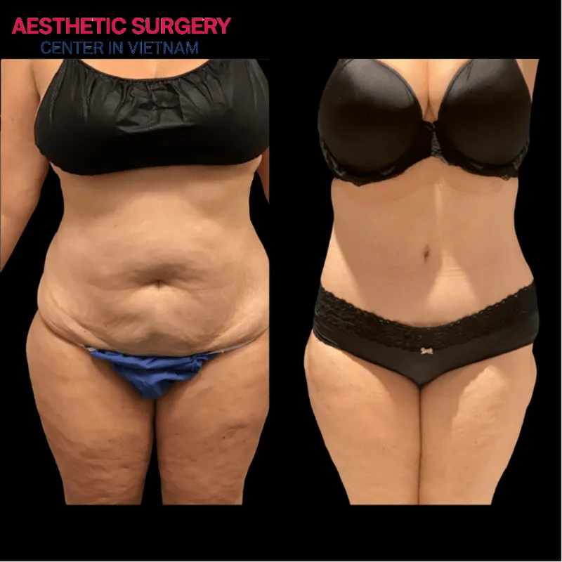 After liposuction, the waistline is smaller, more balanced, and more harmonious with the client's figure