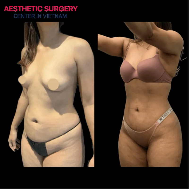 To achieve a slim waist and eliminate excess belly fat, liposuction of the waist area is a viable option