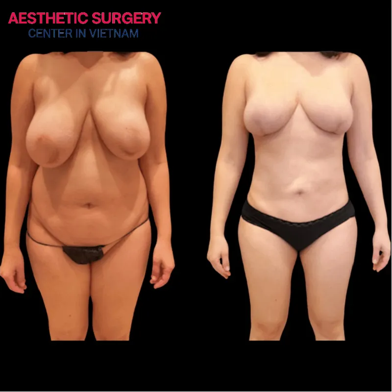 Excess fat around the waist has been removed, giving the client a perfect waistline