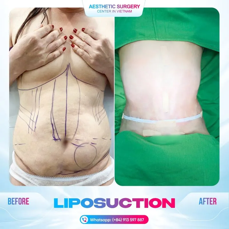 Before and after photos of a client who underwent liposuction on the waist area at Aesthetic Surgery Center in Vietnam