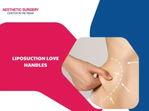 What are liposuction love handles? What is the procedure like?