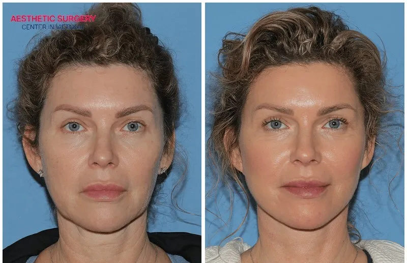 You can see a slimmer and more defined jawline within 2 to 4 weeks.