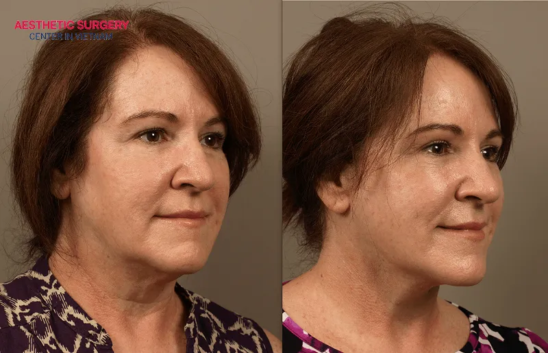 The full recovery time after a lower facelift is usually around 1 to 3 months.