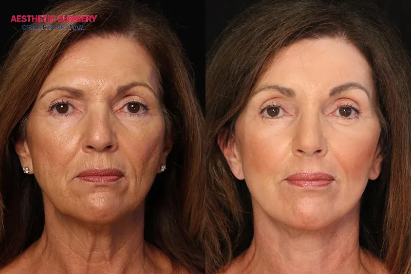 The cost of lower facelift surgery usually ranges from $2,500 to $5,000 and depends on several factors.