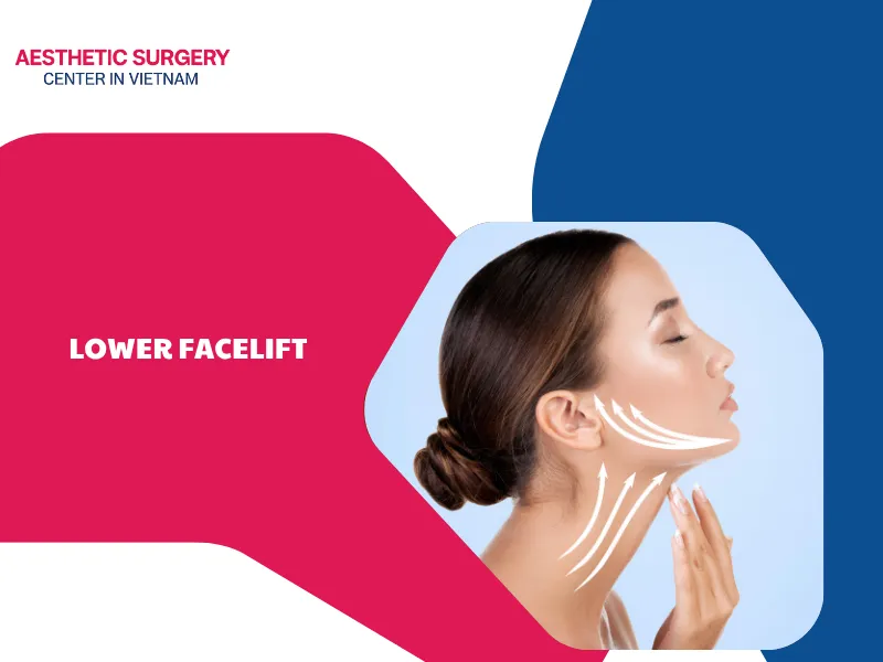 What is a lower facelift? Things you should know about it