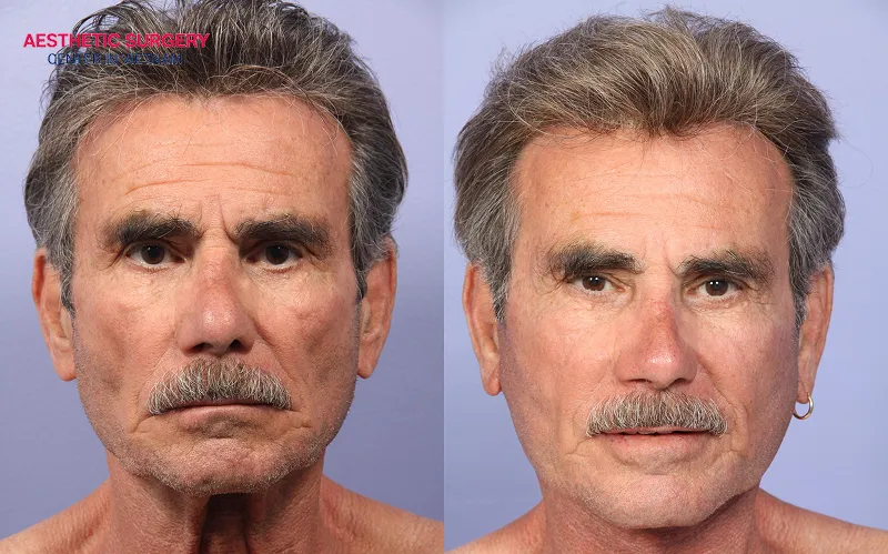 The cost will vary depending on the facelift technique and technology used.