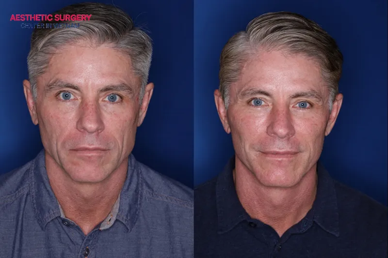 You will need about 1 to 3 months to achieve the best aesthetic results.