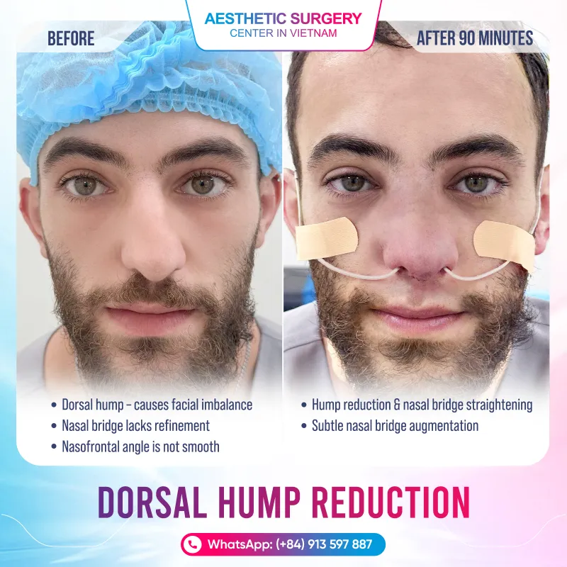 Nowadays, many patients choose Vietnam as a destination for both tourism and cosmetic procedures.