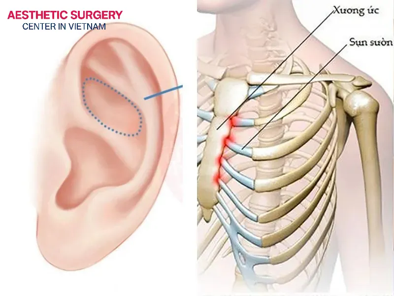 Autologous rib cartilage is harvested from the ribs, providing an abundant supply with high compatibility, minimal complications, and long-lasting durability, but it comes with a high cost.