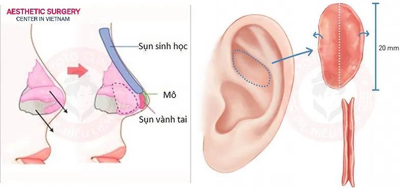 Ear cartilage and septal cartilage offer high compatibility, safety, and natural results, but they have a limited supply and require more complex surgical techniques.
