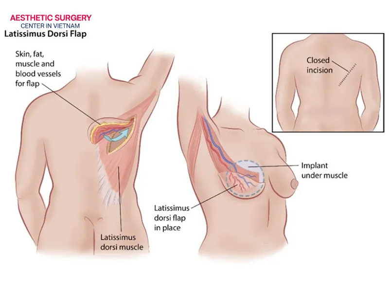 Autologous flap breast reconstruction method
