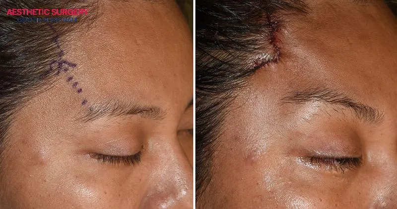The eyebrows are lifted significantly from the temples.