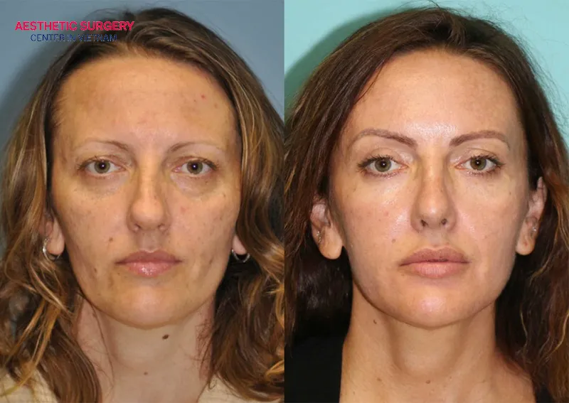 Her face looks more radiant than before the eyebrow lift.
