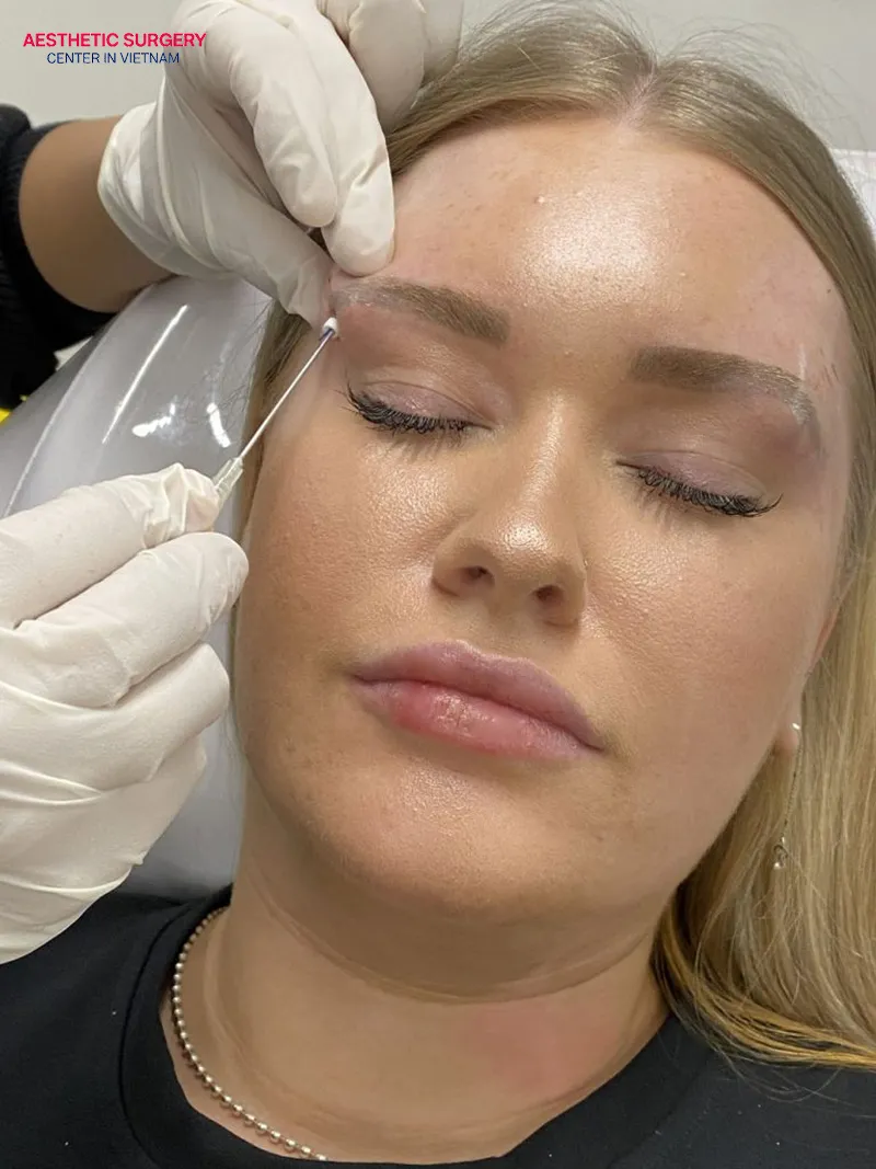 A thread brow lift significantly improves sagging skin and low eyebrows caused by the aging process