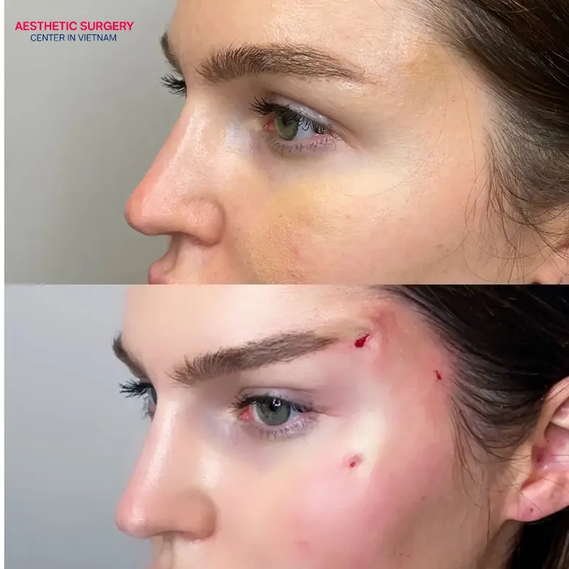 A brow thread lift delivers a natural beauty that is almost instantaneous.