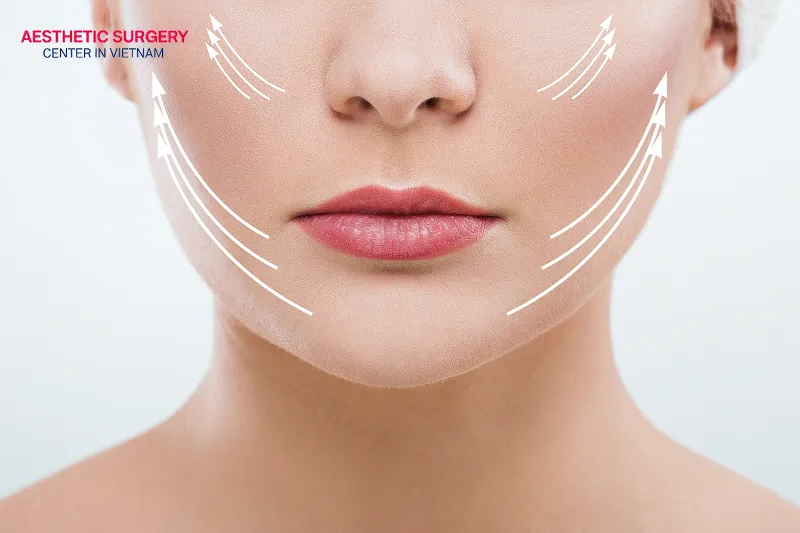 Facial threads facelift treatments in Vietnam currently range from 600 USD to 4,000 USD.