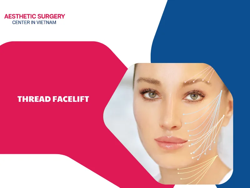 What is a thread facelift? Is this method really effective?
