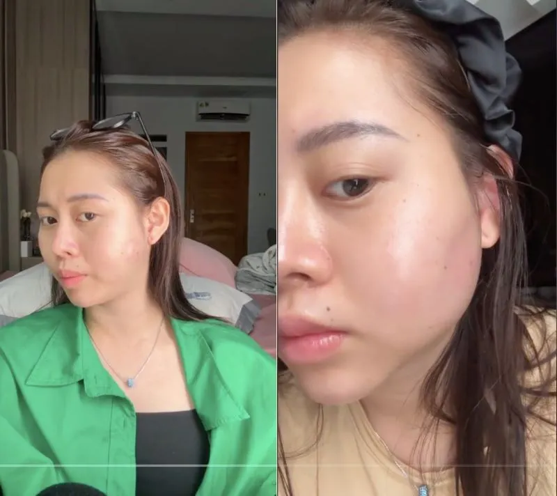 The puffy cheek effect is a common consequence of injecting too much filler