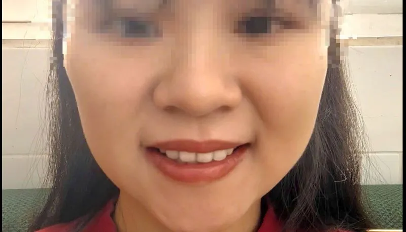 Injecting too much filler in cheeks can cause the filler to migrate