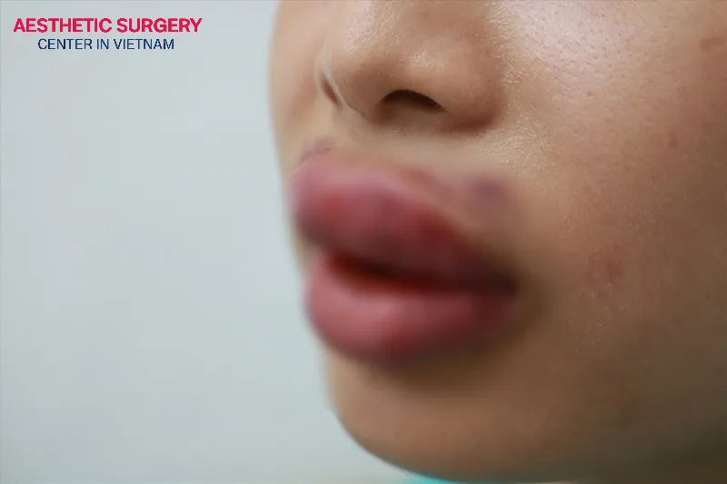 The symptoms of a vascular occlusion lip filler complication include severe pain, skin pallor, skin discoloration, cold skin, and swelling