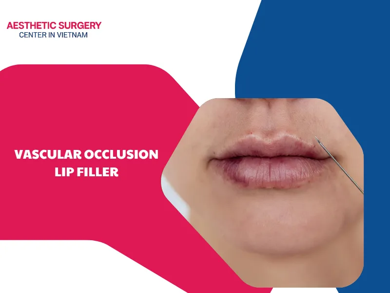 What is vascular occlusion lip filler? Causes and treatments