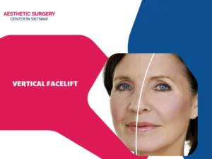 What is a vertical facelift? What are the benefits it offers?