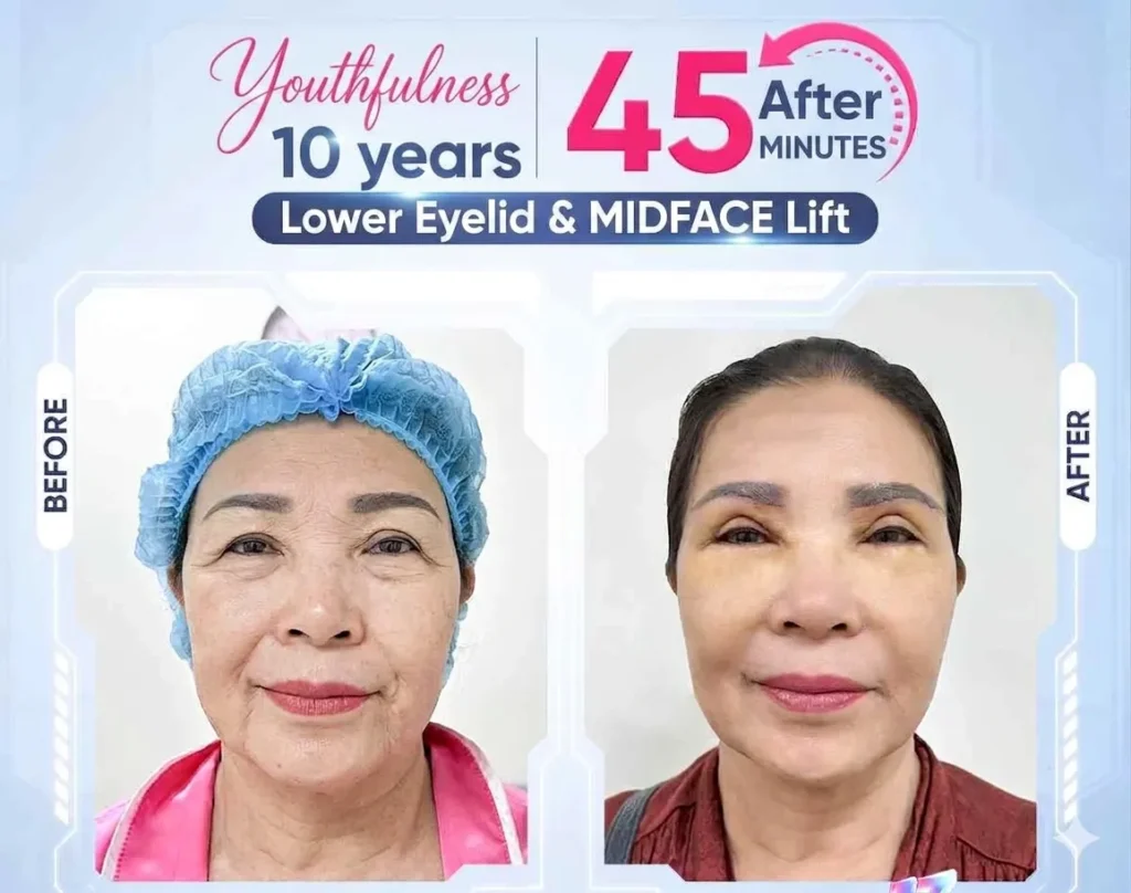 Post-facelift care instructions 