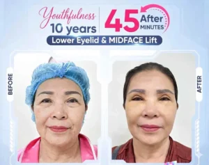 Post-facelift care instructions 