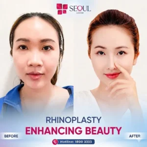 Post-rhinoplasty care instructions 