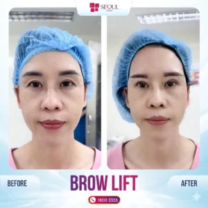 Post-brow lift care instructions 