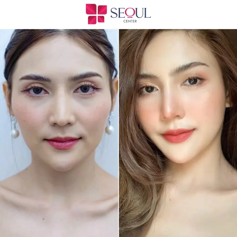After filler injections, clients need to follow strict post-treatment restrictions to prevent swelling, inflammation, infection, and displacement of the filler material.