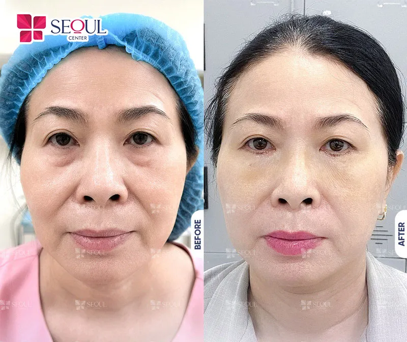 After Botox treatment, you should follow the recommended diet, rest, and daily care instructions to support recovery and help Botox achieve its effects more quickly.