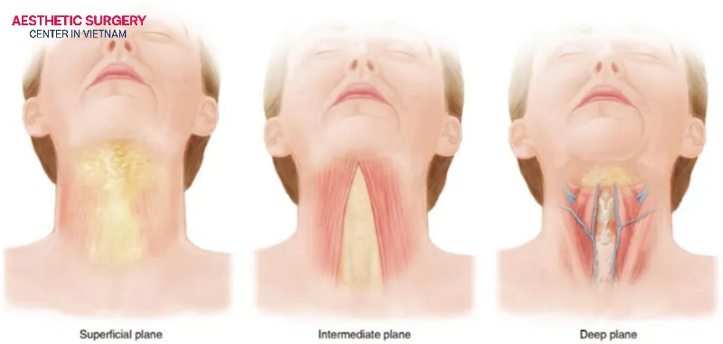 Neck scars are mainly formed based on the surgical technique used in each procedure.