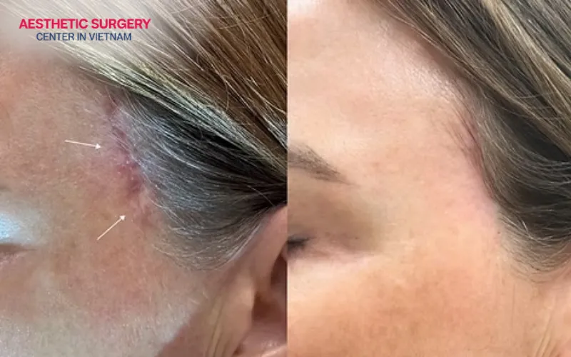 A botched facelift can be recognized by visible scars and a distorted hairline.
