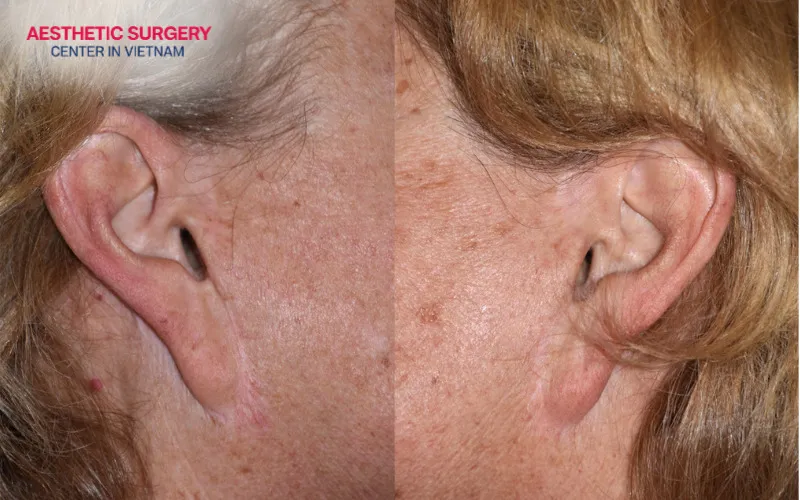 Earlobe deformity can make the face appear less attractive and less harmonious.