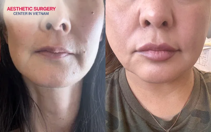 Damage to the facial nerves can have a significant impact on both appearance and overall health.