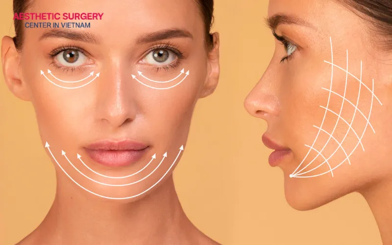 A deep plane facelift can be performed to correct pixie ear deformity and restore facial symmetry.