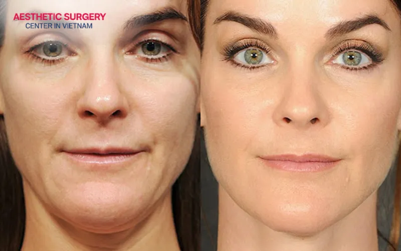 Comprehensive facial reconstruction surgery may be recommended when the previous botched facelift resulted in multiple complications and structural issues.
