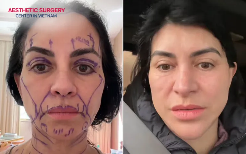 The cost of facelift revision surgery typically starts at 125 million VND.