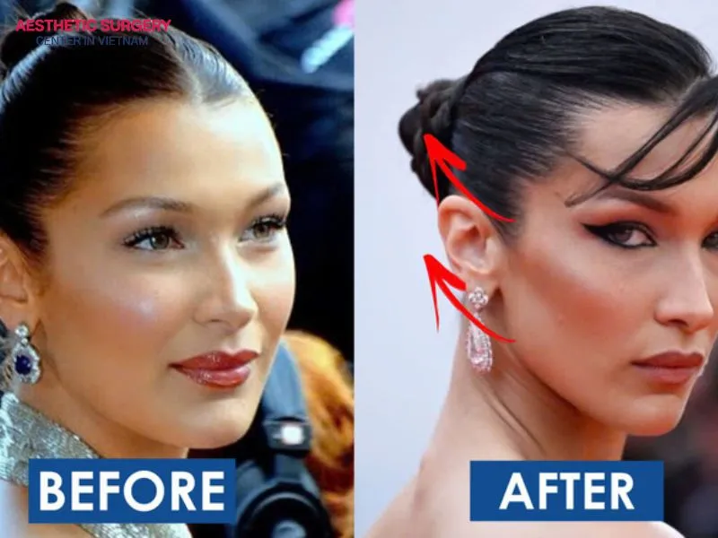 The results of a botox face lift can be maintained for a long time if performed and cared for properly.
