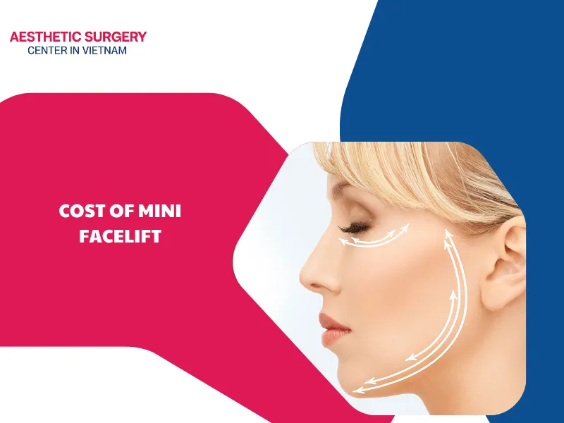 What is the cost of mini facelift? 4 factors that affect price
