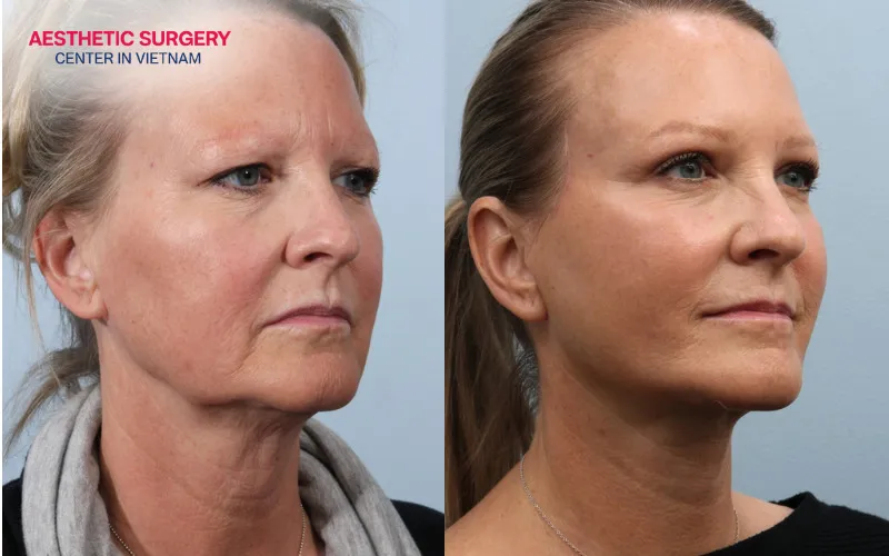 Once the neck has fully settled into its new contour, you may look 5 to 10 years younger.