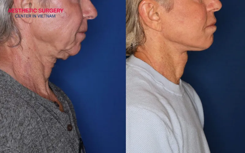 Not only women, but men can also regain a firmer, more defined neck contour, resulting in a more confident and distinguished appearance.