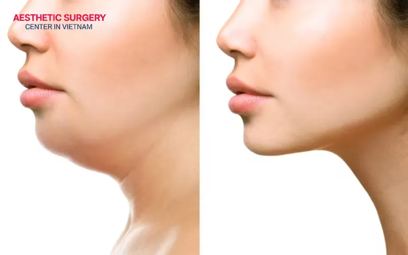 Both men and women with signs of neck aging, such as loose neck skin, a double chin, or turkey neck deformity, may be suitable candidates for a deep plane neck lift.
