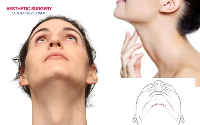The surgical incision is typically made beneath the chin and is kept very short in length.