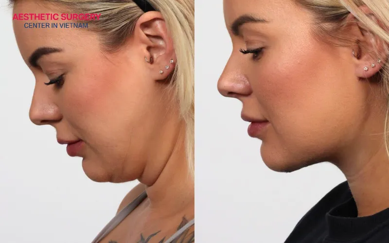 Excess fat and a double chin disappear completely after a deep plane neck lift.